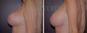 Breast Revision Patient