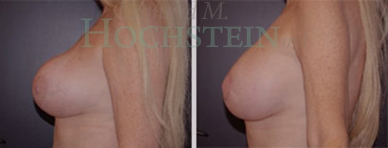 Breast Revision Patient