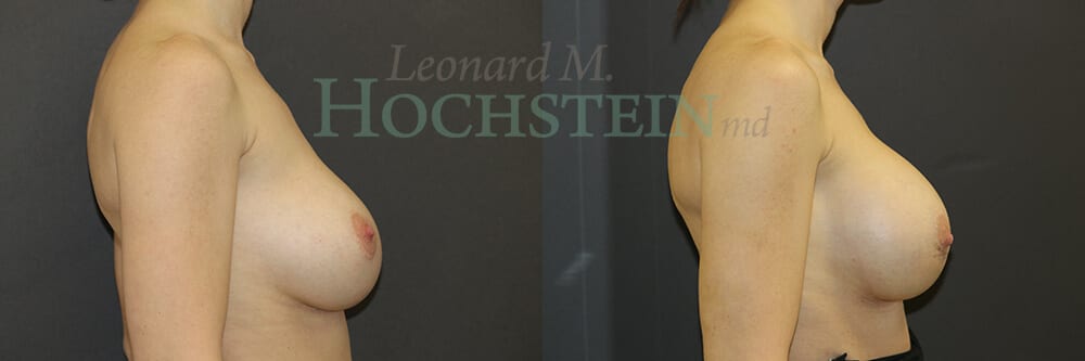 Breast Revision Patient