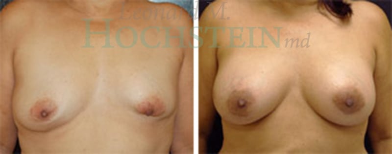 Breast Revision Patient