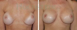 Breast Revision Patient