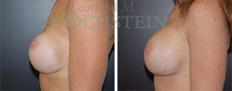 Breast Revision Patient