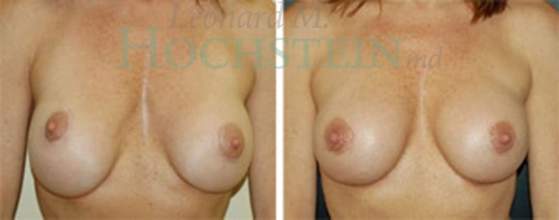 Breast Revision Patient