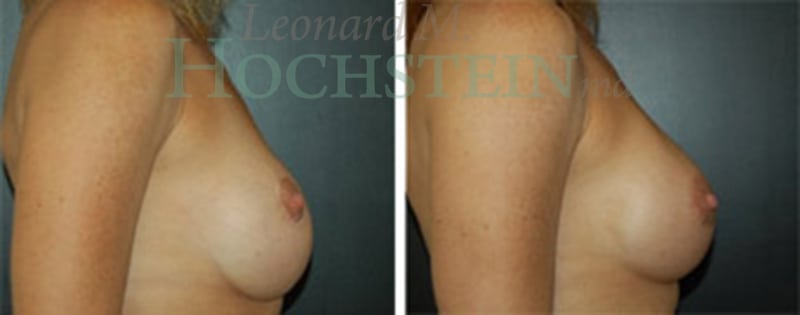 Breast Revision Patient