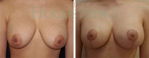 Breast Revision Patient