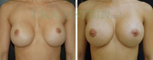 Breast Revision Patient