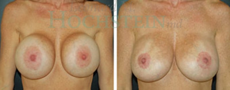 Breast Revision Patient