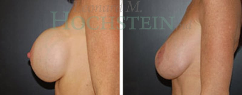 Breast Revision Patient