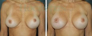Breast Revision Patient