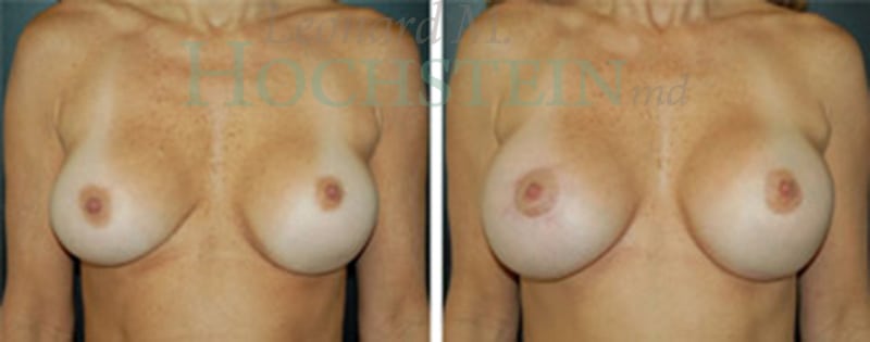 Breast Revision Patient