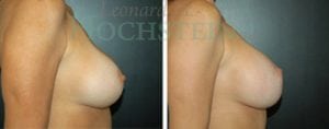 Breast Revision Patient