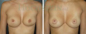 Breast Revision Patient