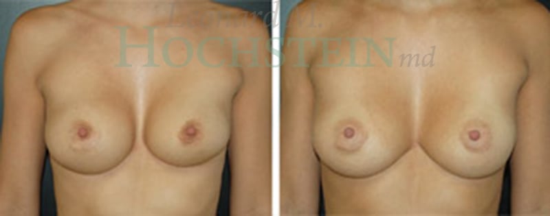 Breast Revision Patient
