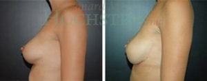 Breast Revision Patient