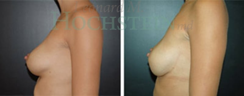 Breast Revision Patient