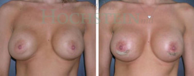 Breast Revision Patient