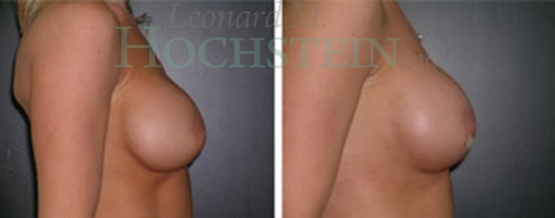 Breast Revision Patient