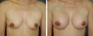 Breast Revision Patient