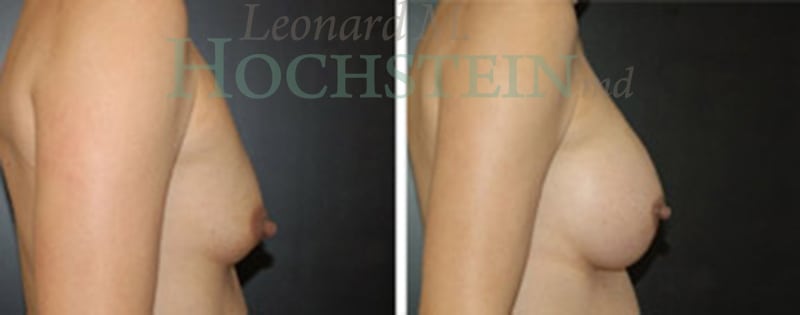 Breast Revision Patient