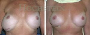 Breast Revision Patient