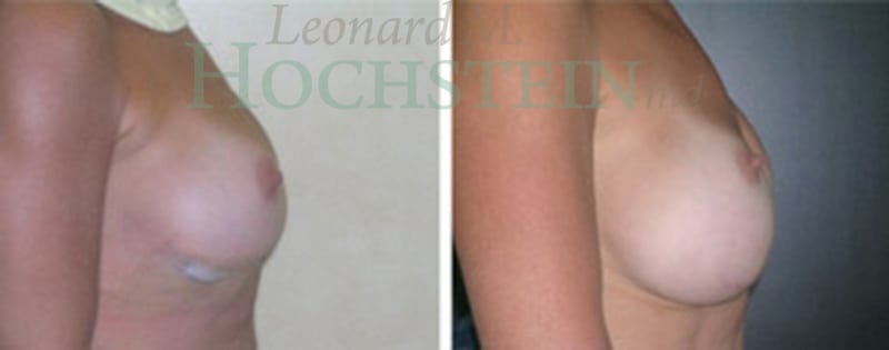 Breast Revision Patient