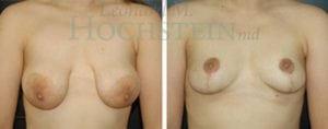 Breast Revision Patient 35