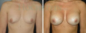 Breast Revision Patient