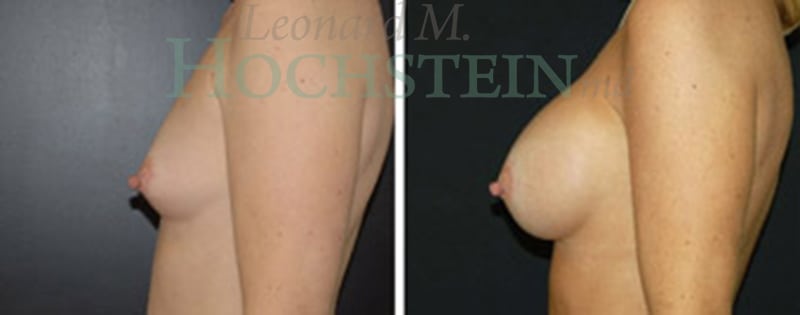 Breast Revision Patient