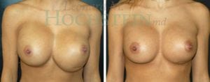 Breast Revision Patient