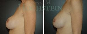 Breast Revision Patient