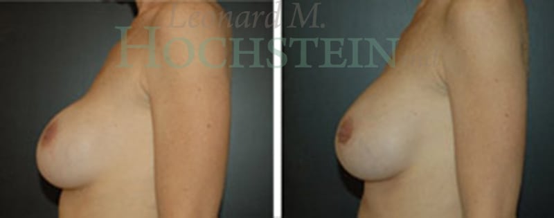 Breast Revision Patient