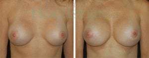 Breast Revision Patient