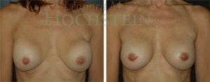 Breast Revision Patient