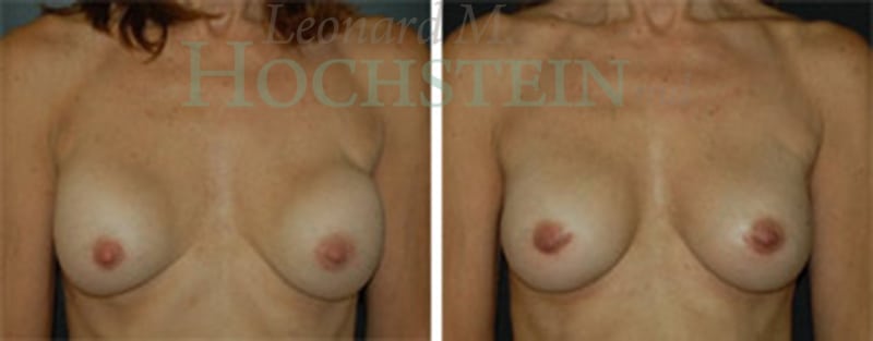 Breast Revision Patient