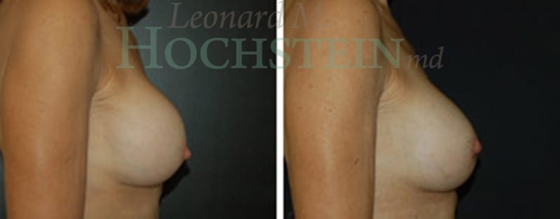 Breast Revision Patient