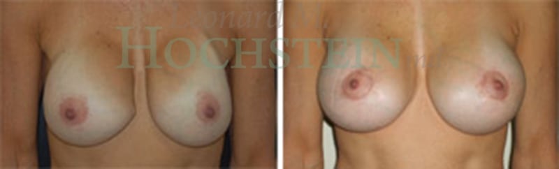 Breast Revision Patient