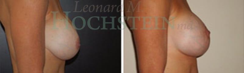 Breast Revision Patient