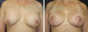 Breast Revision Patient