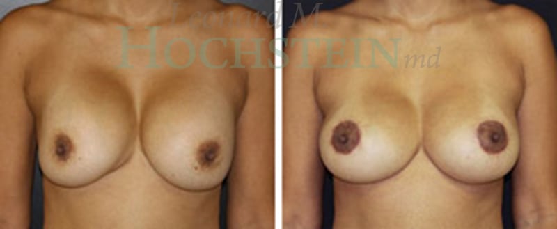 Breast Revision Patient