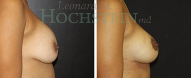 Breast Revision Patient