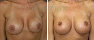 Breast Revision Patient