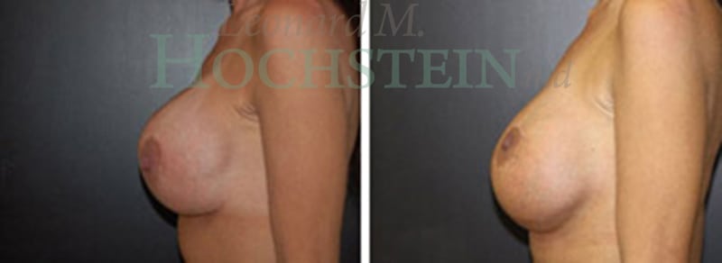 Breast Revision Patient