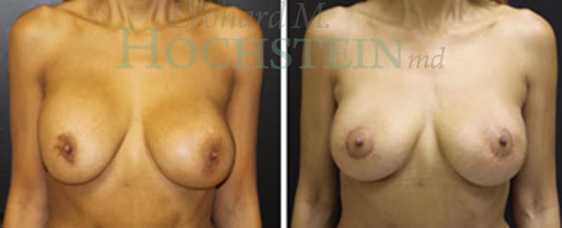 Breast Revision Patient
