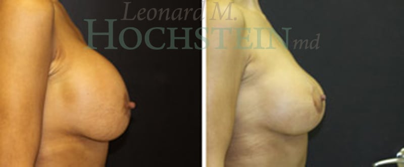 Breast Revision Patient