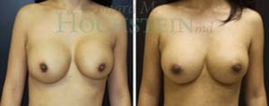 Breast Revision Patient
