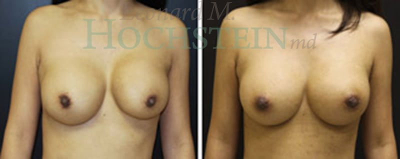 Breast Revision Patient