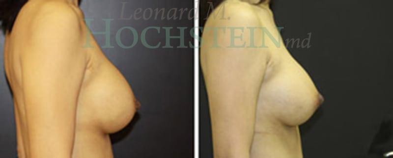 Breast Revision Patient