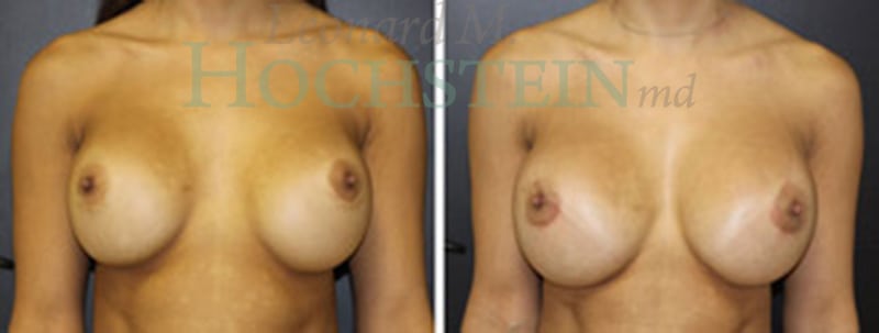 Breast Revision Patient