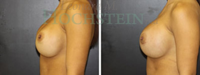 Breast Revision Patient