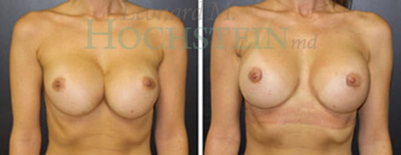 Breast Revision Patient